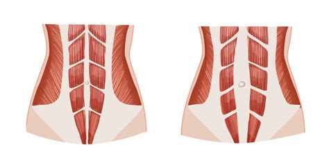 Ilustrácia svalov brucha a celkového telesného tuku