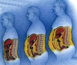 Ilustrácia zobrazujúca rozdelenie brušného tuku na viscerálny a podkožný.