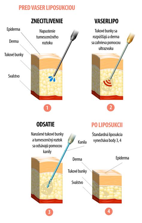 Schéma ultrazvukovej liposukcie VASER Lipo® s vyznačením pôsobenia ultrazvuku na tukové bunky a odsávania emulzie