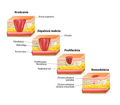 Infografika zobrazujúca proces hojenia po liposukcii