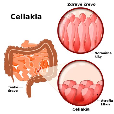 Ilustrácia tenkého čreva, znázorňujúca poškodené klky pri celiakii.