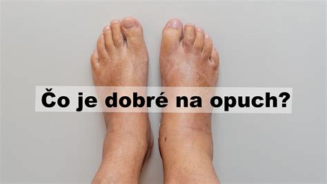 Ilustrácia opuchnutých členkov a nôh ako príznak srdcového zlyhávania