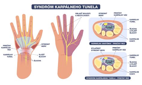 Infografika zobrazujúca rozdiely medzi typickou a atypickou baktériou, s dôrazom na vnútrobunkový parazitizmus chlamýdií.