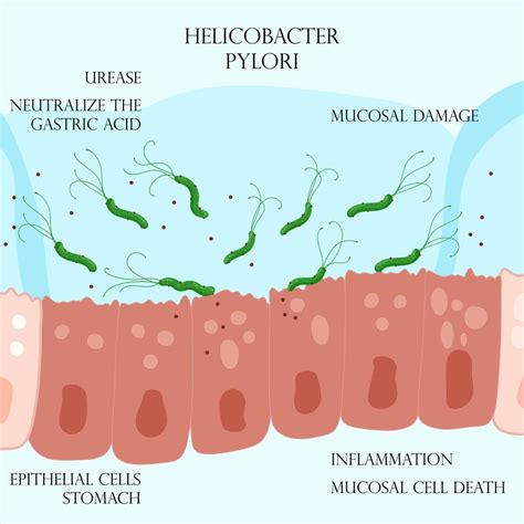 Ilustrácia baktérií Helicobacter pylori na sliznici žalúdka