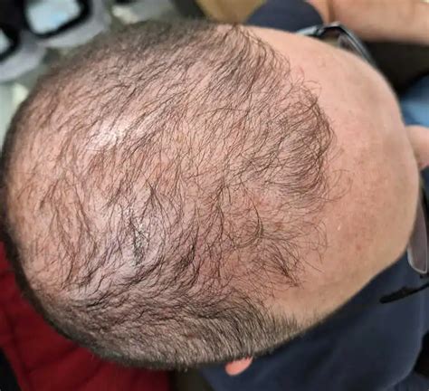 Koláž znázorňujúca rôzne negatívne dôsledky rýchleho chudnutia (strie, vypadávanie vlasov, únava)