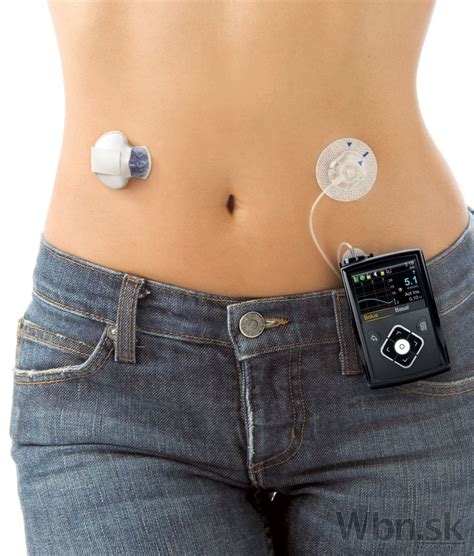 obrázok diabetika užívajúceho inzulínovú pumpu