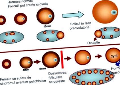 ilustrácia vaječníkov so syndrómom polycystických vaječníkov