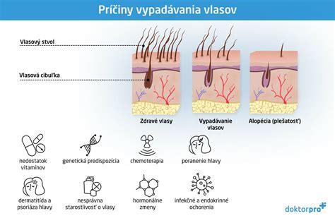 ilustrácia znázorňujúca rôzne príčiny vypadávania vlasov