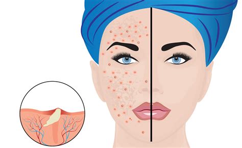 Ilustrácia ženy aplikujúcej náplasť na akné na tvár