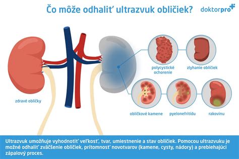 Infografika zobrazujúca percentuálne rozšírenie ochorení obličiek vo svete