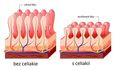 infografika s príznakmi celiakie a schémou poškodeného tenkého čreva