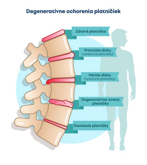 Ilustrácia detskej chrbtice s deformitou