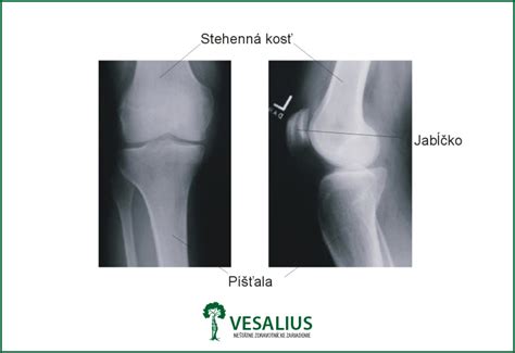 Röntgenový snímok kolenného kĺbu s osteoartrózou