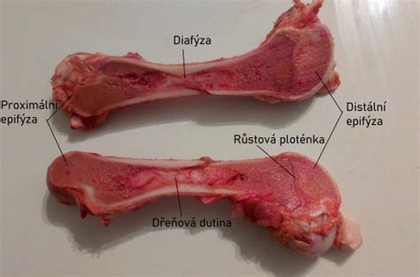 Ilustrácia kostí postihnutých krivicou a osteomaláciou