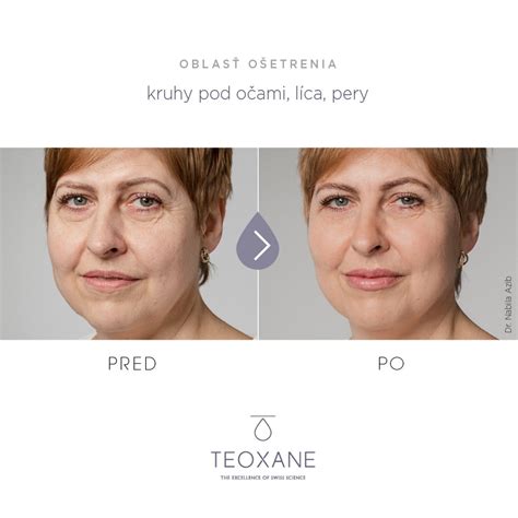 Ilustrácia aplikácie kyseliny hyalurónovej do prsného tkaniva