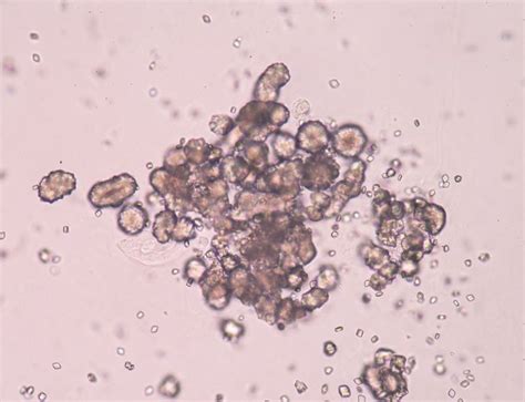 farebná schéma znázorňujúca ukladanie kryštálov kyseliny močovej v kĺbe a vznik zápalu