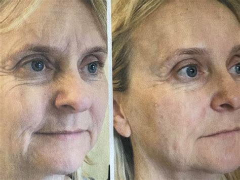 Ilustračná fotografia ženy pred a po liposukcii brucha