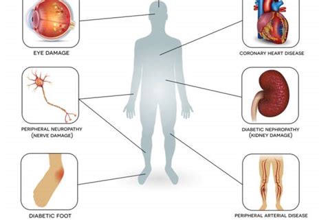 Schéma ukazujúca poškodenie ciev obličiek vplyvom diabetu