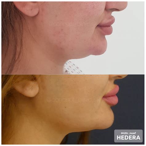 schéma priebehu liposukcie podbradku