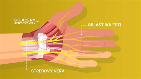 Obrázok zobrazujúci rôzne typy bandáží a ortéz na zápästie, ako aj príklady cvičení na rehabilitáciu.