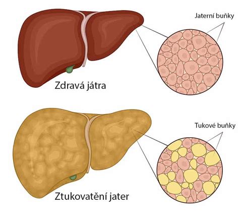 Ilustrácia znázorňujúca nadmerné ukladanie telesného tuku v tele.