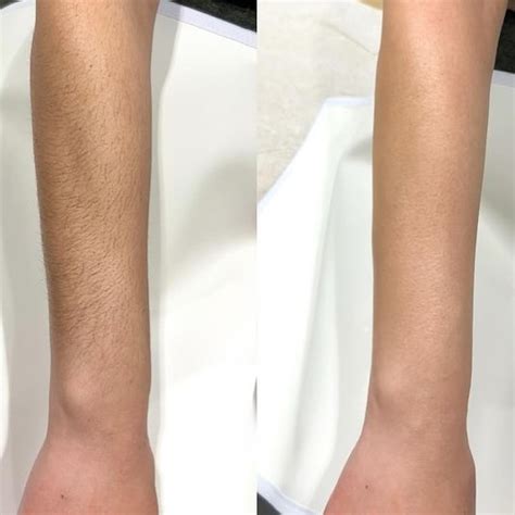 porovnanie pokožky pred a po laserovej epilácii