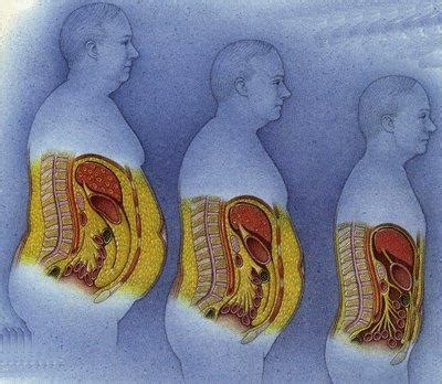 Ilustrácia rozloženia viscerálneho a podkožného tuku