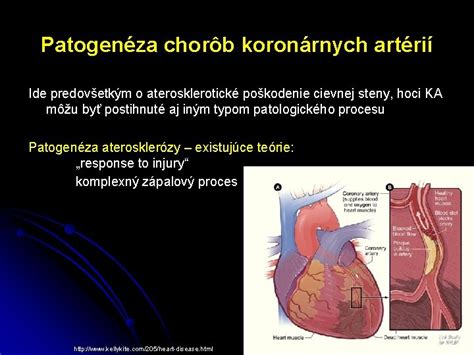 Ilustrácia cievnej steny postihnutej aterosklerózou