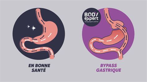 ilustrácia znázorňujúca sleeve gastrektómiu a žalúdočný bypass
