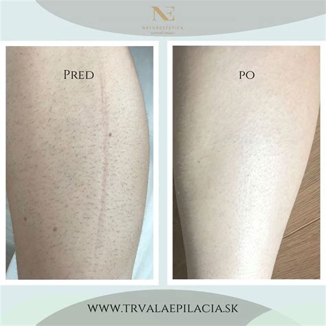 Schéma fungovania diódového lasera pri odstraňovaní chĺpkov