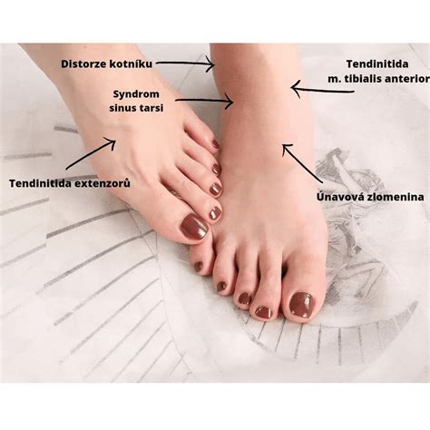 Ilustrácia dnavého záchvatu v kĺbe palca nohy