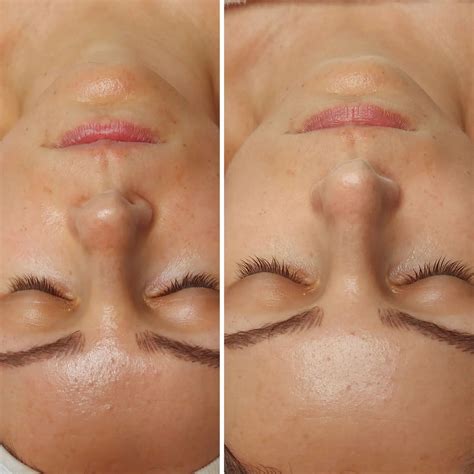 fotografia: pred a po ošetrení LPG na bruchu/stehnách