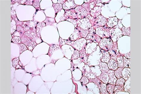 Schéma: Rozdiel medzi hyperpláziou a hypertrofiou tukových buniek