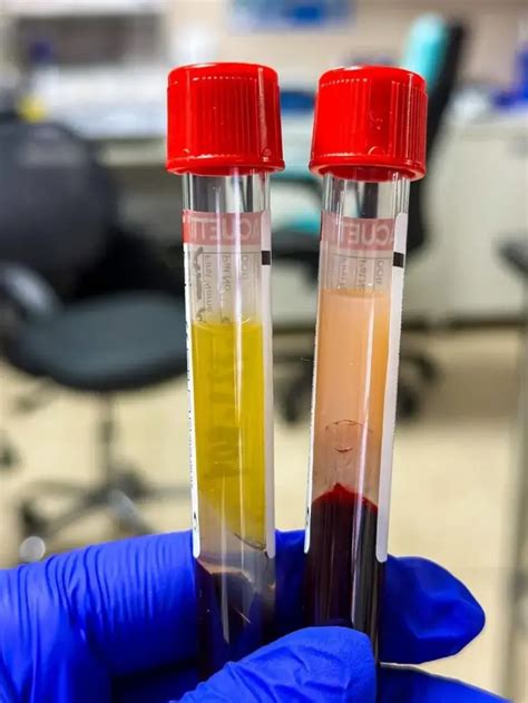 porovnanie normálnej a chylóznej krvi