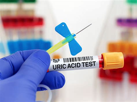 Infografika s rizikovými faktormi a prejavmi zvýšenej kyseliny močovej