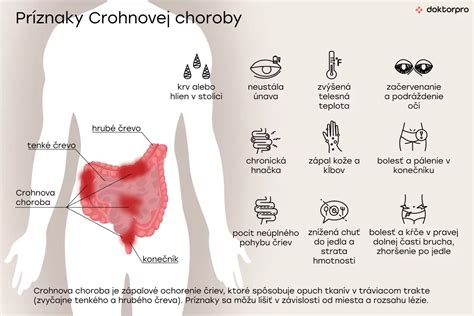 Tabuľka porovnávajúca príznaky, postihnutie čreva a stravovacie odporúčania pri Crohnovej chorobe a ulceróznej kolitíde.