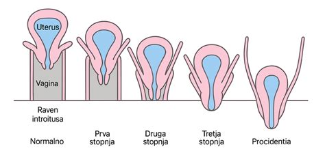 Schéma panvového dna znázorňujúca normálnu polohu maternice a jej postupný pokles (prolaps) v rôznych štádiách.
