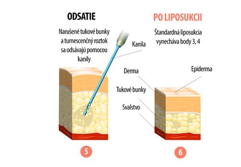 Schéma znázorňujúca proces liposukcie a miesta najčastejšieho výskytu tuku (brucho, boky, stehná)