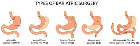 Schéma porovnania zdravej anatómie žalúdka a rôznych typov bariatrických zákrokov (sleeve, bypass, plikácia)