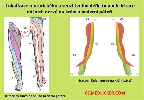 Ilustrácia mechanizmu hernie: tlak na platničku a následný útlak nervového koreňa