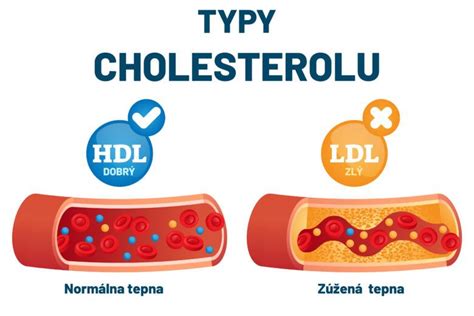 infografika vysvetľujúca dobrý a zlý cholesterol