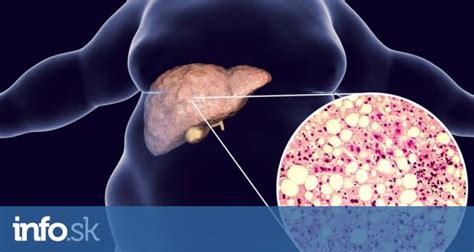 Infografika: Progresia stukovatenej pečene (steatóza -> steatohepatitída -> fibróza -> cirhóza)