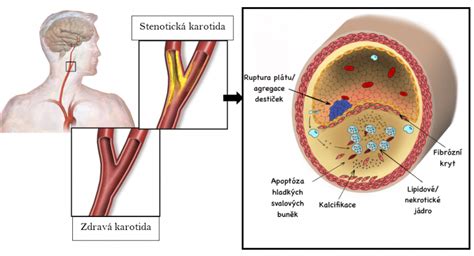 Ilustračná schéma ukazujúca vplyv aterosklerózy na cievy.