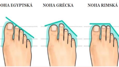 Ilustrácia rôznych typov deformít prstov na nohe