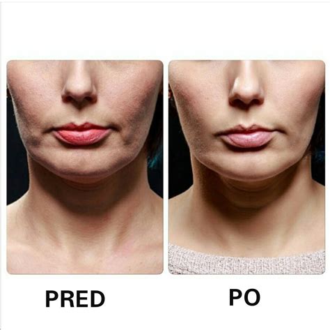 infografika znázorňujúca prepojenie medzi celkovou redukciou tuku a úbytkom v oblasti tváre