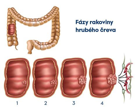 Ilustračná schéma hrubého čreva s vyznačenými oblasťami, ktoré sa vyšetrujú pri kolonoskopii