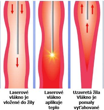 Schéma laserovej liečby kŕčových žíl