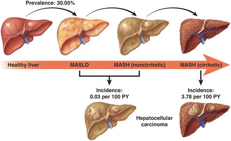 Infografika s porovnaním bežných mýtov a faktov o MASLD