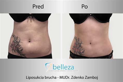 ilustrácia zobrazujúca rôzne oblasti tela, ktoré je možné ošetriť liposukciou