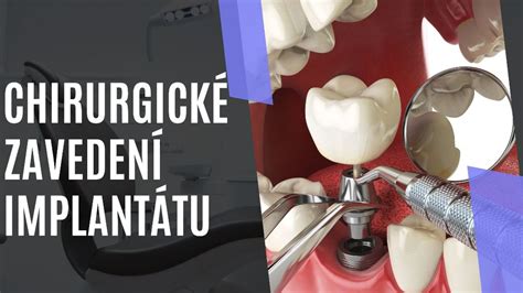Schematické znázornenie subfasciálneho a submuskulárneho umiestnenia lýtkového implantátu
